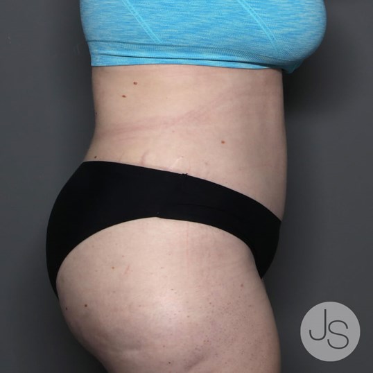 Tummy Tuck Before and After Pictures Beverly Hills, CA