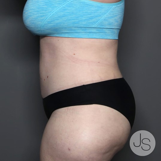 Tummy Tuck Before and After Pictures Beverly Hills, CA