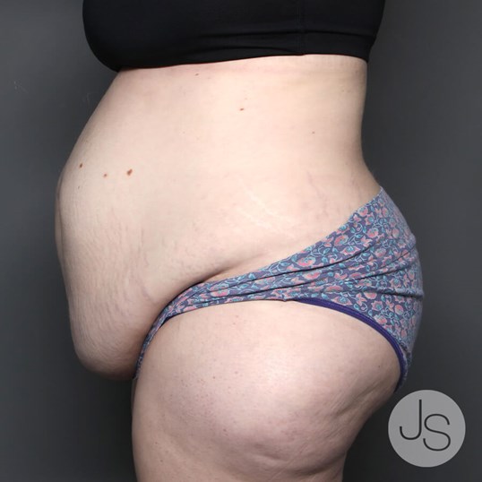 Tummy Tuck Before and After Pictures Beverly Hills, CA