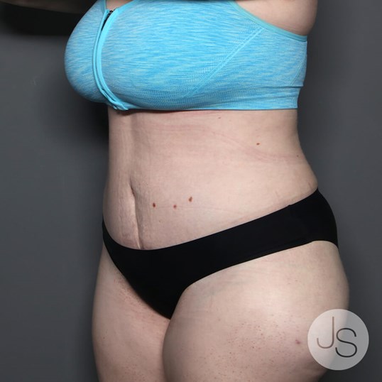 Tummy Tuck Before and After Pictures Beverly Hills, CA