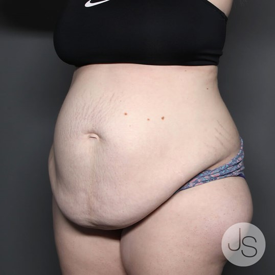 Tummy Tuck Before and After Pictures Beverly Hills, CA