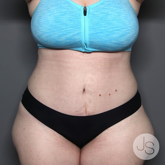 Tummy Tuck Before and After Pictures Beverly Hills, CA