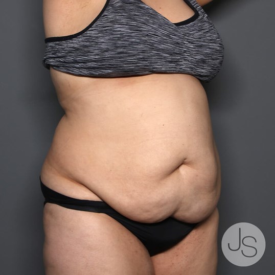 Tummy Tuck Before and After Pictures Beverly Hills, CA