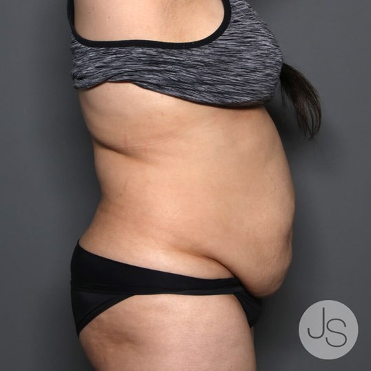 Tummy Tuck Before and After Pictures Beverly Hills, CA