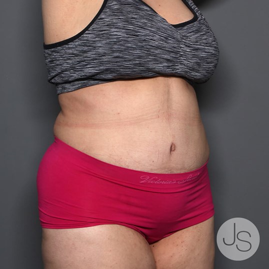 Tummy Tuck Before and After Pictures Beverly Hills, CA