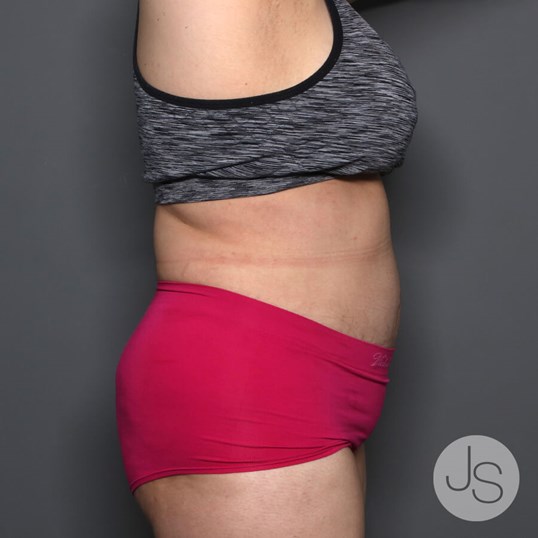 Tummy Tuck Before and After Pictures Beverly Hills, CA