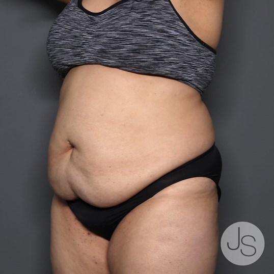 Tummy Tuck Before and After Pictures Beverly Hills, CA