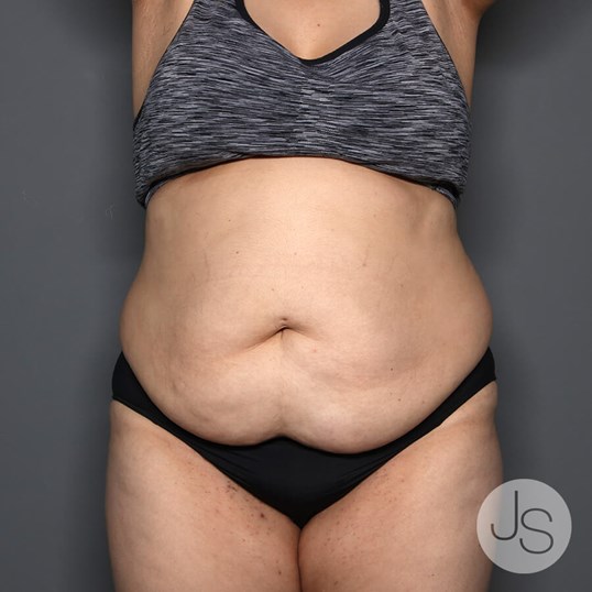 Tummy Tuck Before and After Pictures Beverly Hills, CA