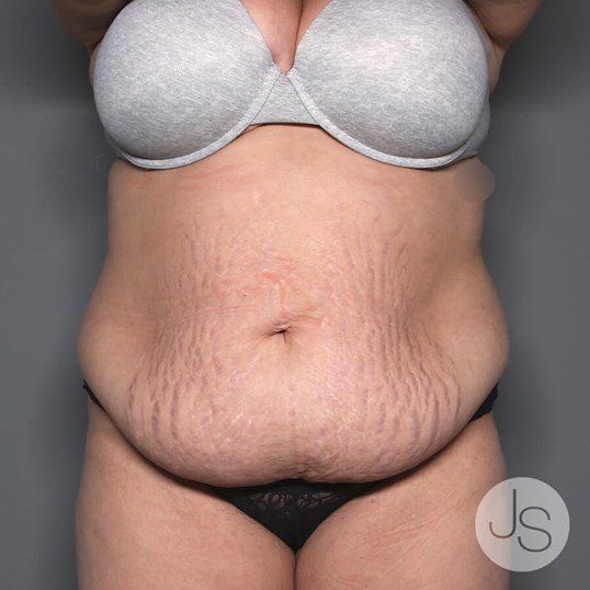 Tummy Tuck Before and After Pictures Beverly Hills, CA