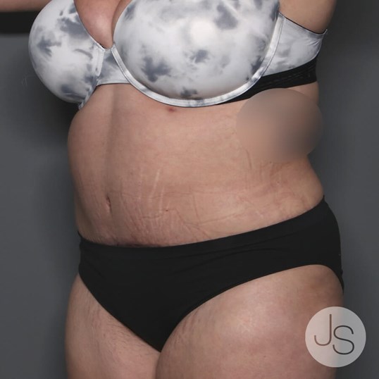 Tummy Tuck Before and After Pictures Beverly Hills, CA