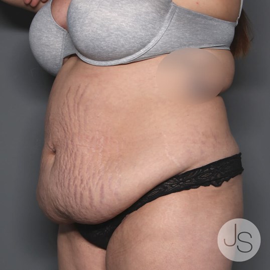 Tummy Tuck Before and After Pictures Beverly Hills, CA