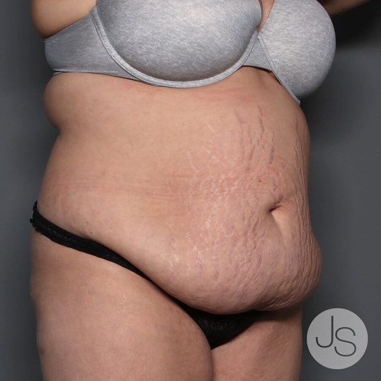 Tummy Tuck Before and After Pictures Beverly Hills, CA