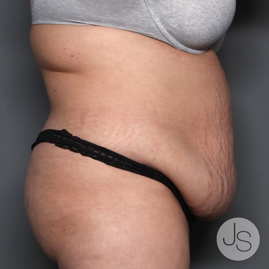 Mommy Makeover Before and After Pictures Beverly Hills, CA
