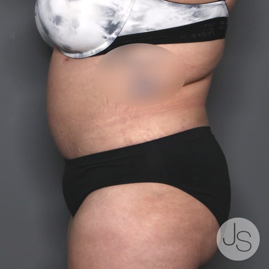 Tummy Tuck Before and After Pictures Beverly Hills, CA