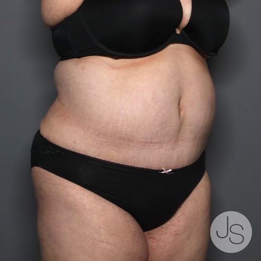 Tummy Tuck Before and After Pictures Beverly Hills, CA