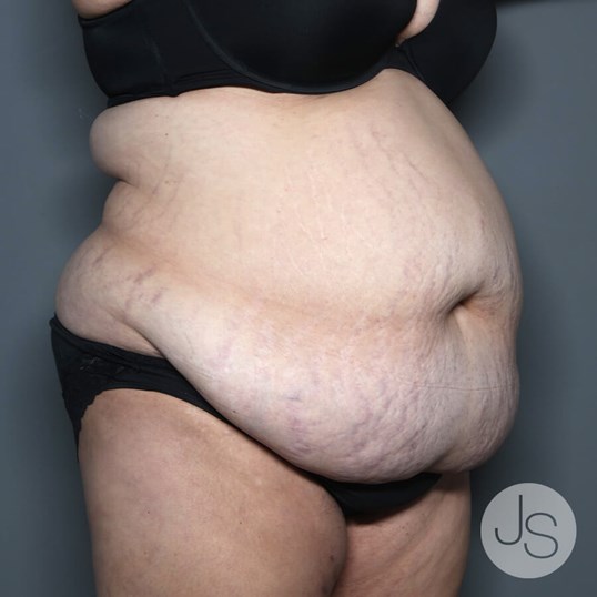 Tummy Tuck Before and After Pictures Beverly Hills, CA