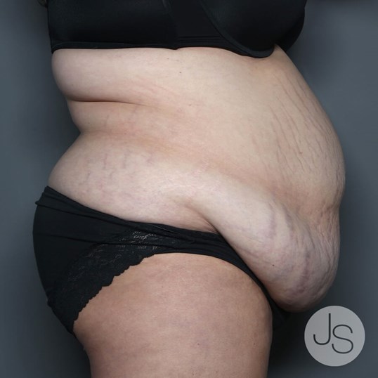 Tummy Tuck Before and After Pictures Beverly Hills, CA