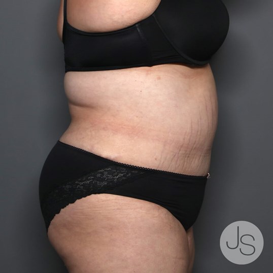 Tummy Tuck Before and After Pictures Beverly Hills, CA