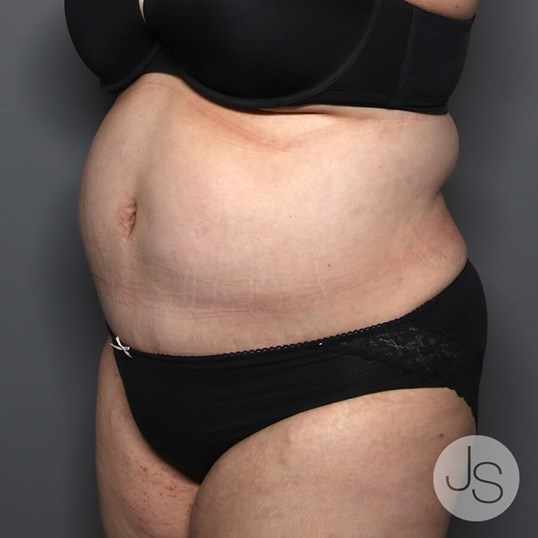 Tummy Tuck Before and After Pictures Beverly Hills, CA