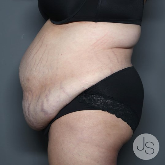 Tummy Tuck Before and After Pictures Beverly Hills, CA