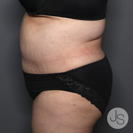 Tummy Tuck Before and After Pictures Beverly Hills, CA