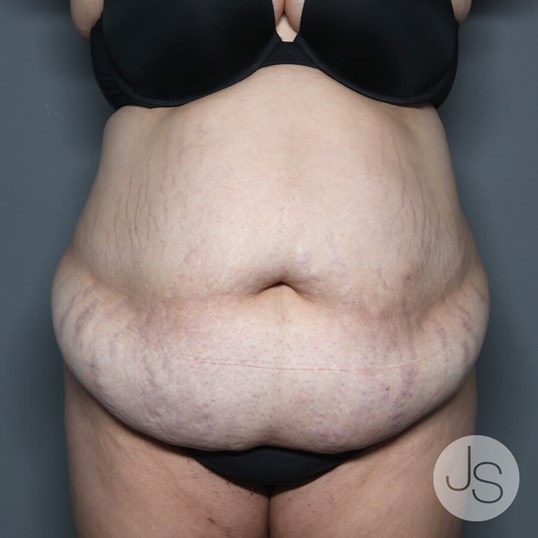 Tummy Tuck Before and After Pictures Beverly Hills, CA