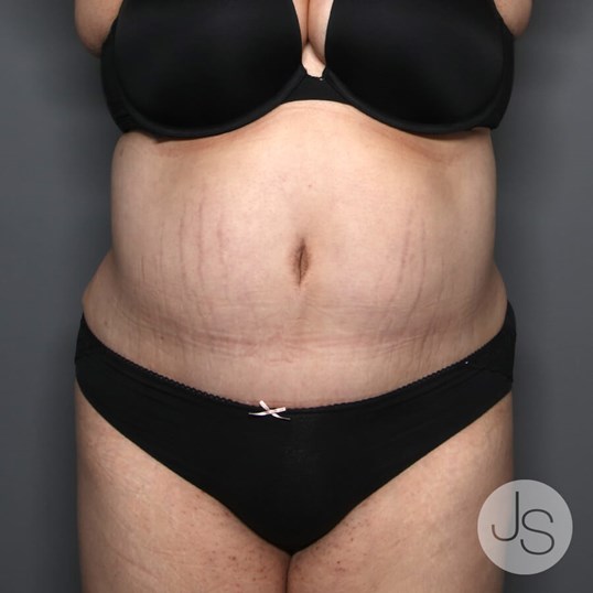 Tummy Tuck Before and After Pictures Beverly Hills, CA