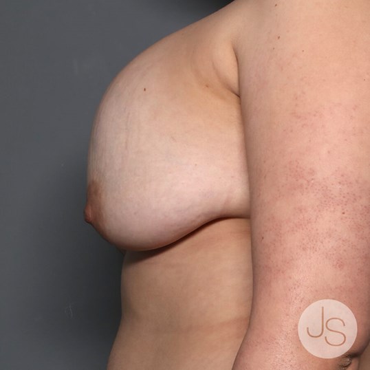 Breast Revision Before and After Pictures Beverly Hills, CA