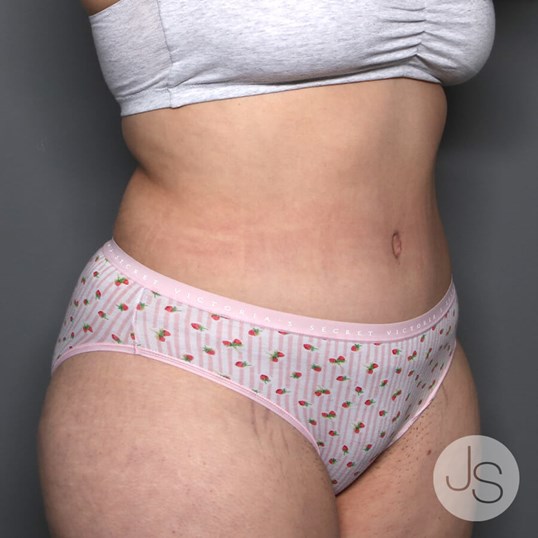 Tummy Tuck Before and After Pictures Beverly Hills, CA