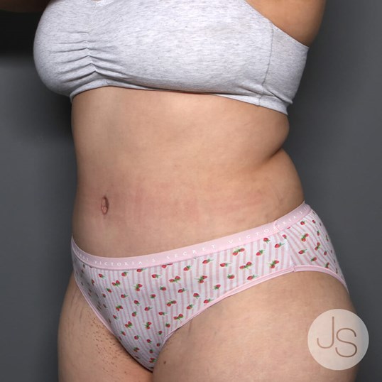 Tummy Tuck Before and After Pictures Beverly Hills, CA