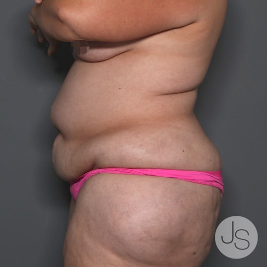 Tummy Tuck Before and After Pictures Beverly Hills, CA