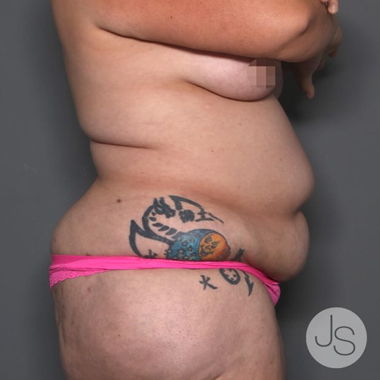 Tummy Tuck Before and After Pictures Beverly Hills, CA