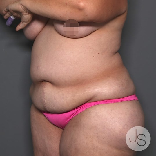 Tummy Tuck Before and After Pictures Beverly Hills, CA