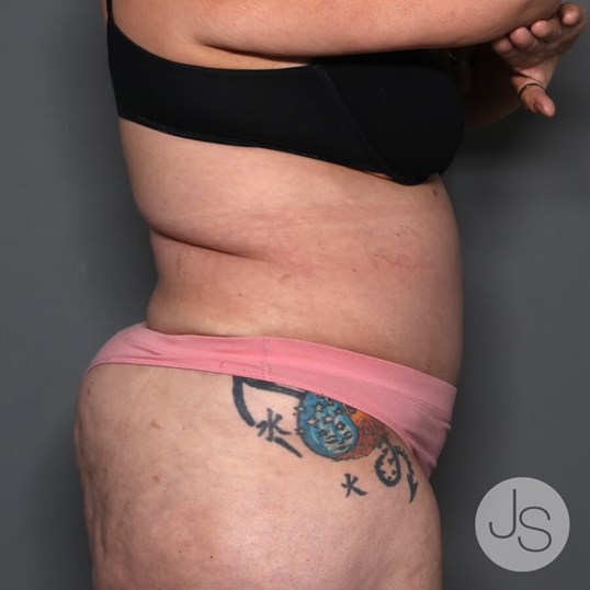 Tummy Tuck Before and After Pictures Beverly Hills, CA