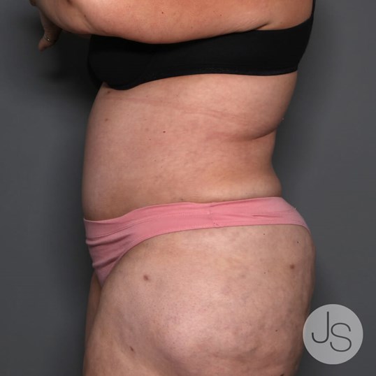 Tummy Tuck Before and After Pictures Beverly Hills, CA