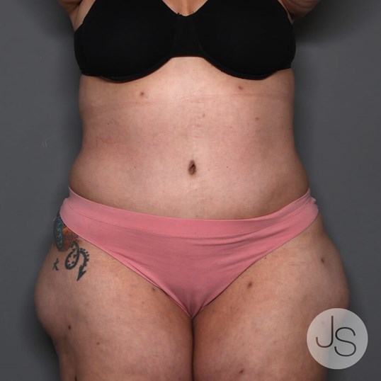 Tummy Tuck Before and After Pictures Beverly Hills, CA