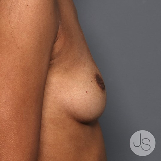 Breast Lift Before and After Pictures Beverly Hills, CA