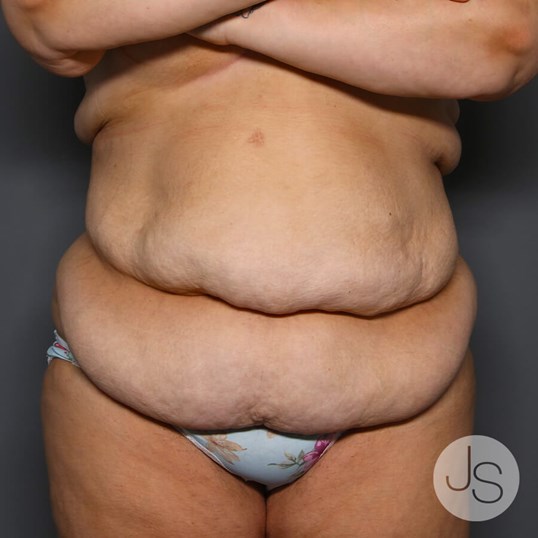 After Weight Loss Surgery Before and After Pictures Beverly Hills, CA