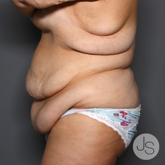 Tummy Tuck Before and After Pictures Beverly Hills, CA