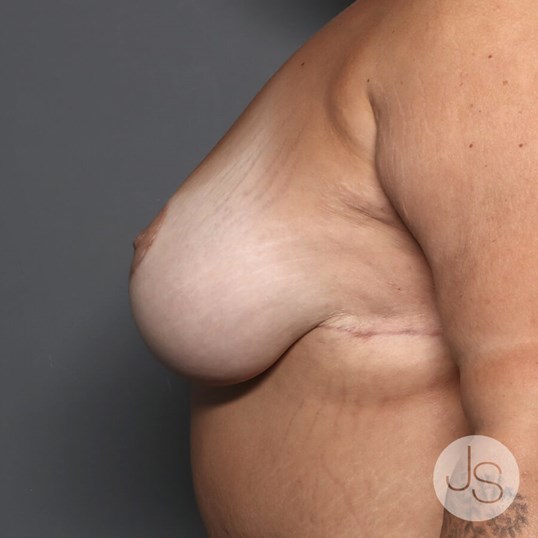 Breast Lift Before and After Pictures Beverly Hills, CA