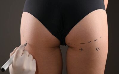 BBL with Renuva: A Booty-boosting Procedure You May Not Know About, Butt Should