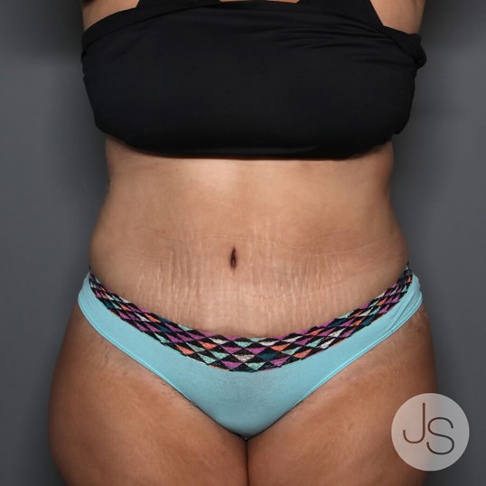 Tummy Tuck Before and After Pictures Beverly Hills, CA