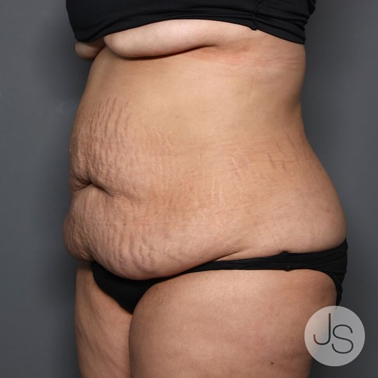 Tummy Tuck Before and After Pictures Beverly Hills, CA