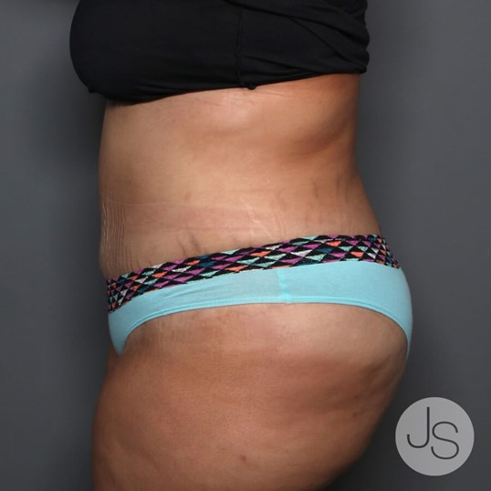 Tummy Tuck Before and After Pictures Beverly Hills, CA