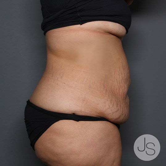 Tummy Tuck Before and After Pictures Beverly Hills, CA