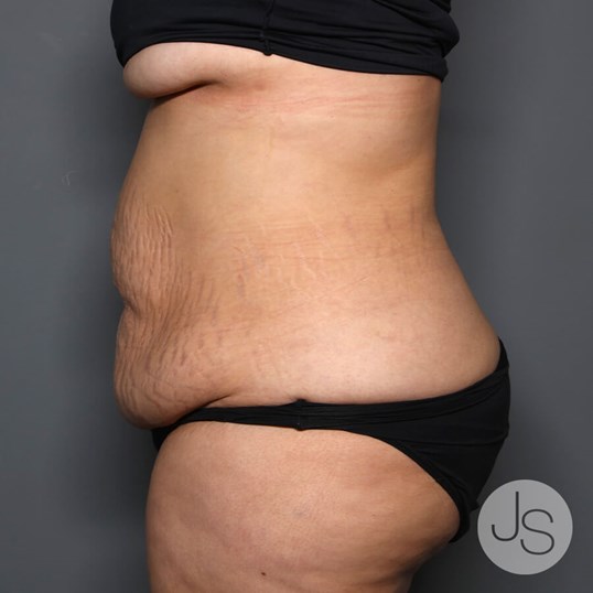 Tummy Tuck Before and After Pictures Beverly Hills, CA