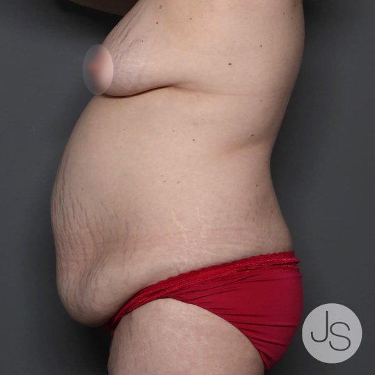 Tummy Tuck Before and After Pictures Beverly Hills, CA