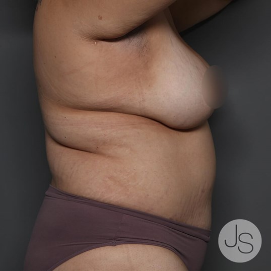 Tummy Tuck Before and After Pictures Beverly Hills, CA