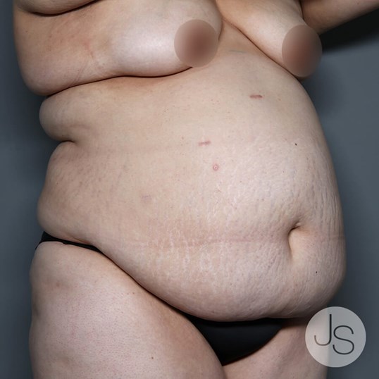 Tummy Tuck Before and After Pictures Beverly Hills, CA