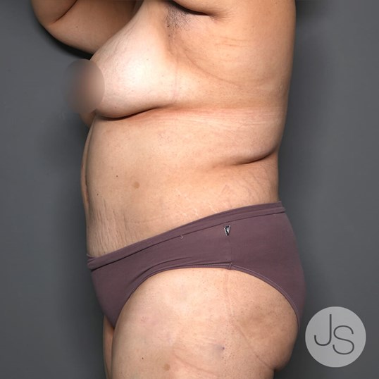 Tummy Tuck Before and After Pictures Beverly Hills, CA